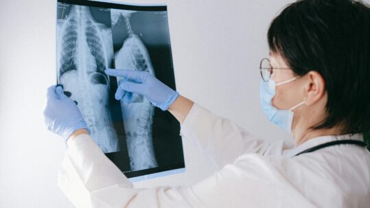 Fibrosis pulmonar en Monterrey